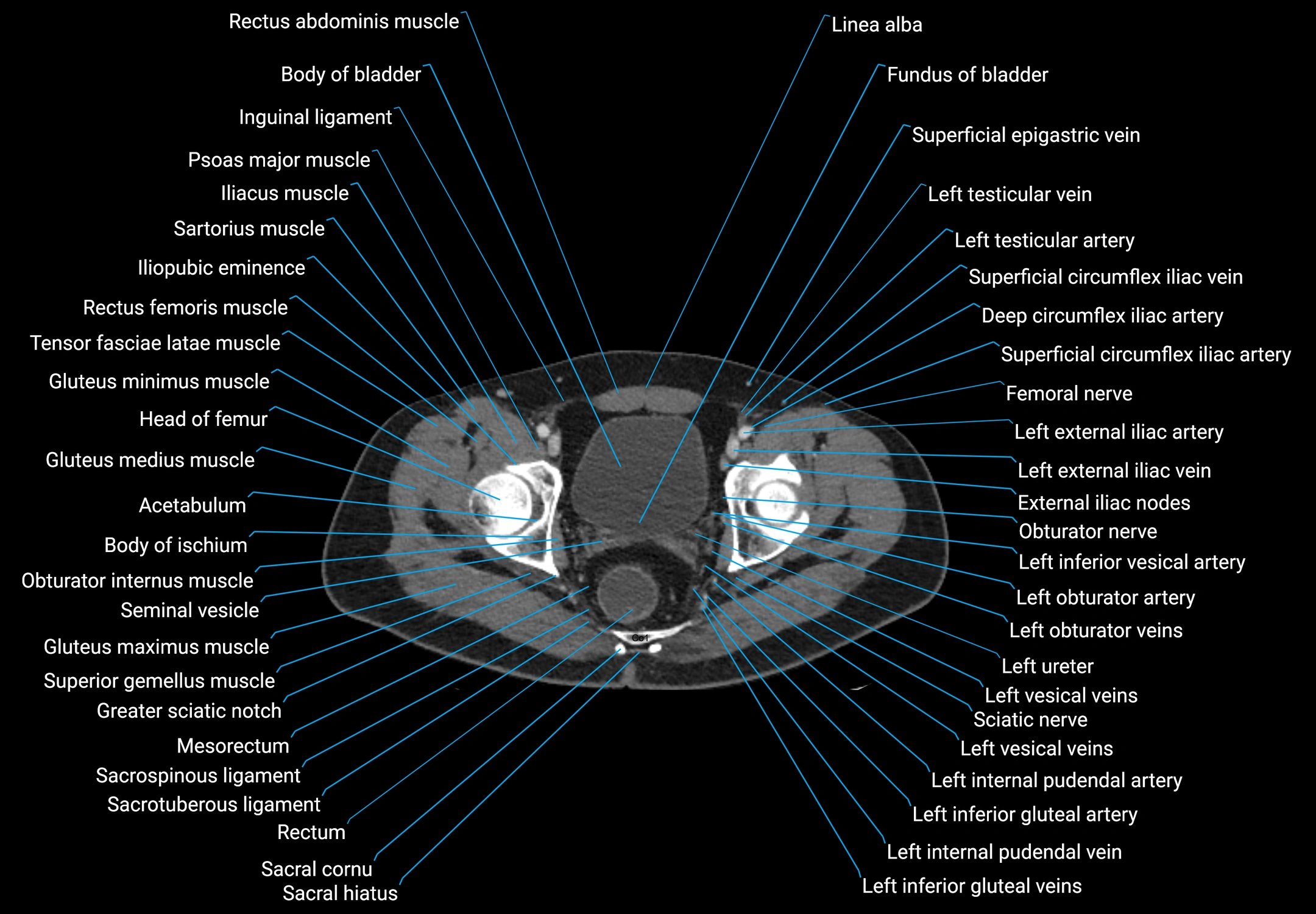 CT male pelvis axial cross sectional anatomy labelled radiology image -00181.webp